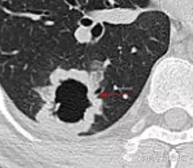 【病例】空腔型肺癌1例CT影像诊断与分析 【病例】空腔型肺癌1例CT影像诊断与分析