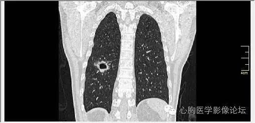 【病例】空腔型肺癌1例CT影像诊断与分析 【病例】空腔型肺癌1例CT影像诊断与分析
