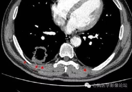【病例】空腔型肺癌1例CT影像诊断与分析 【病例】空腔型肺癌1例CT影像诊断与分析