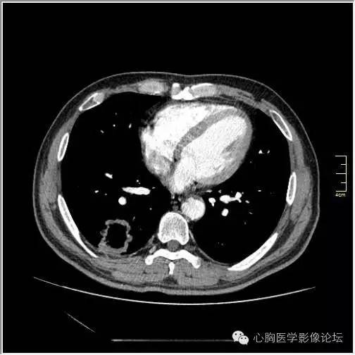 【病例】空腔型肺癌1例CT影像诊断与分析 【病例】空腔型肺癌1例CT影像诊断与分析