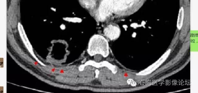 【病例】空腔型肺癌1例CT影像诊断与分析 【病例】空腔型肺癌1例CT影像诊断与分析