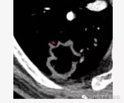 【病例】空腔型肺癌1例CT影像诊断与分析 【病例】空腔型肺癌1例CT影像诊断与分析