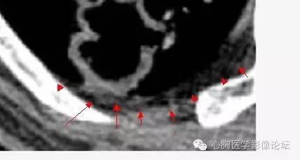 【病例】空腔型肺癌1例CT影像诊断与分析 【病例】空腔型肺癌1例CT影像诊断与分析