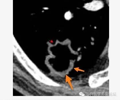 【病例】空腔型肺癌1例CT影像诊断与分析 【病例】空腔型肺癌1例CT影像诊断与分析