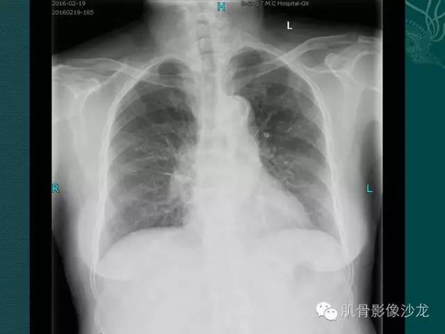 【病例】胸壁弹力纤维瘤1例MR影像表现