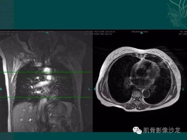 【病例】胸壁弹力纤维瘤1例MR影像表现