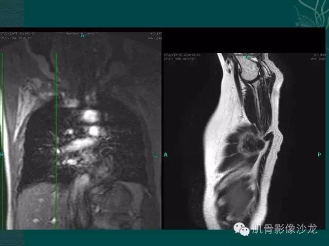 【病例】胸壁弹力纤维瘤1例MR影像表现