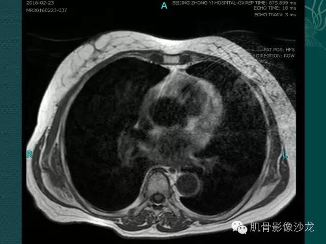 【病例】胸壁弹力纤维瘤1例MR影像表现