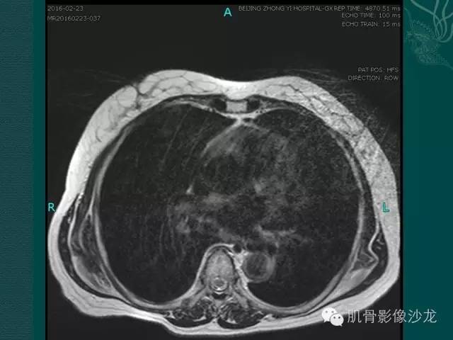 【病例】胸壁弹力纤维瘤1例MR影像表现