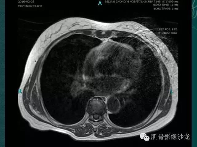 【病例】胸壁弹力纤维瘤1例MR影像表现
