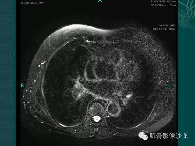 【病例】胸壁弹力纤维瘤1例MR影像表现