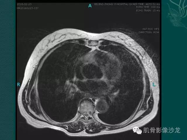 【病例】胸壁弹力纤维瘤1例MR影像表现