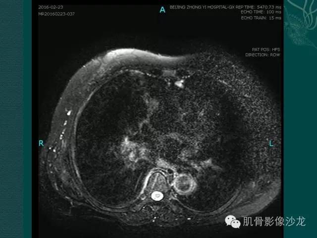 【病例】胸壁弹力纤维瘤1例MR影像表现