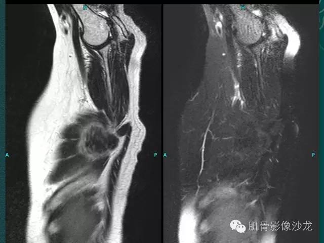 【病例】胸壁弹力纤维瘤1例MR影像表现