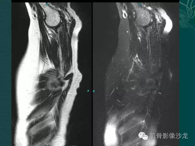 【病例】胸壁弹力纤维瘤1例MR影像表现
