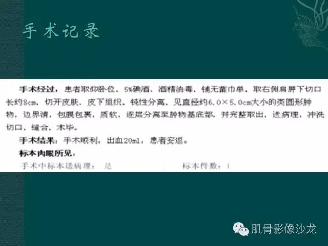 【病例】胸壁弹力纤维瘤1例MR影像表现