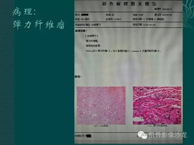 【病例】胸壁弹力纤维瘤1例MR影像表现