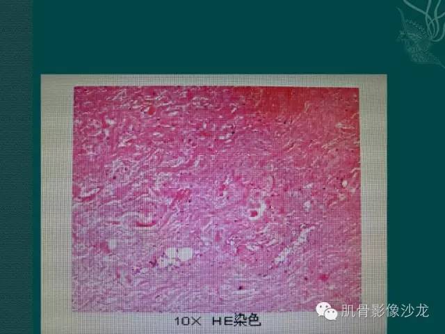 【病例】胸壁弹力纤维瘤1例MR影像表现