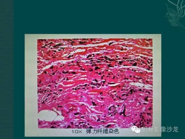 【病例】胸壁弹力纤维瘤1例MR影像表现