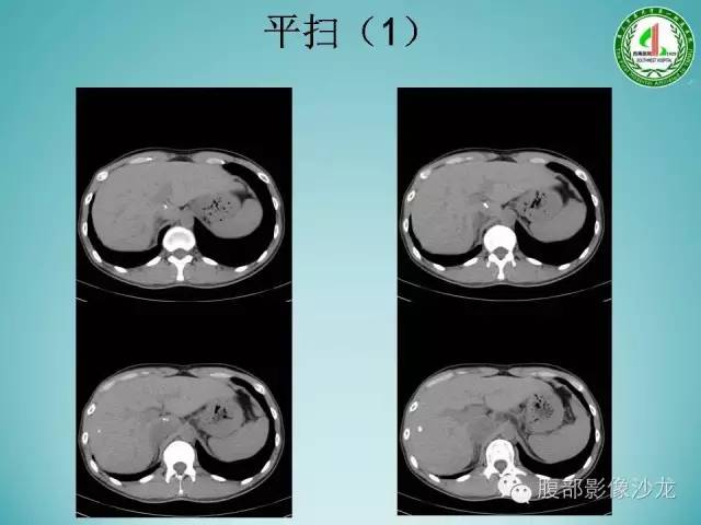 【病例】腹膜后嗜铬细胞瘤1例