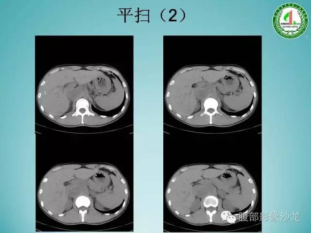 【病例】腹膜后嗜铬细胞瘤1例
