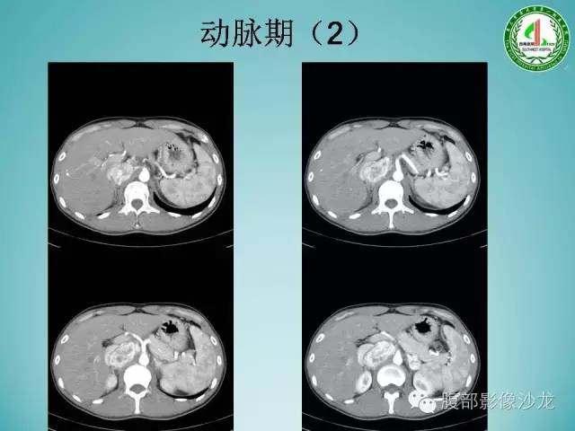 【病例】腹膜后嗜铬细胞瘤1例