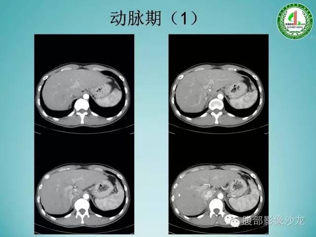 【病例】腹膜后嗜铬细胞瘤1例