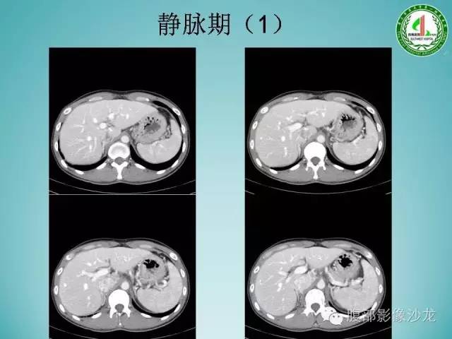 【病例】腹膜后嗜铬细胞瘤1例