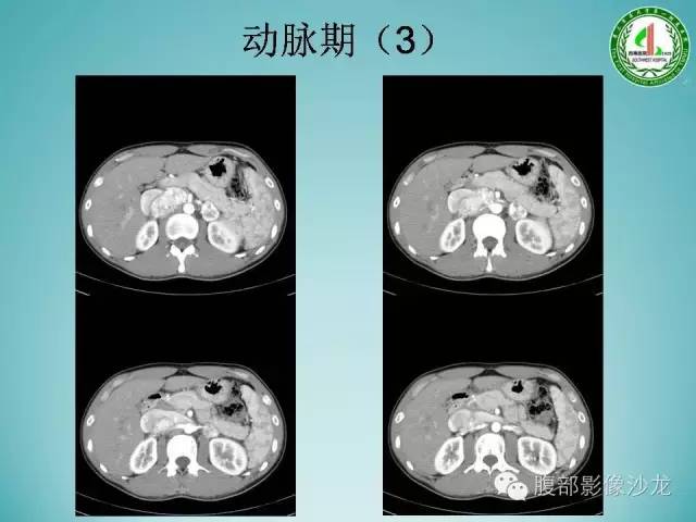 【病例】腹膜后嗜铬细胞瘤1例