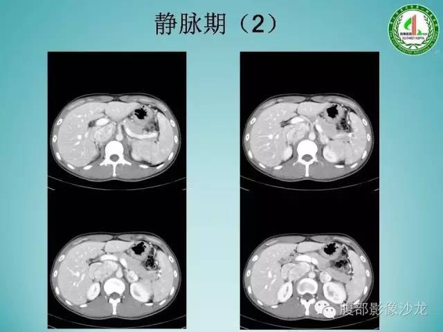 【病例】腹膜后嗜铬细胞瘤1例