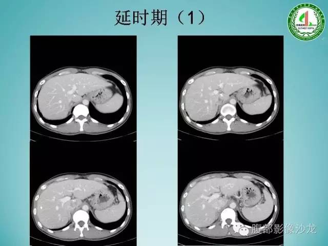 【病例】腹膜后嗜铬细胞瘤1例