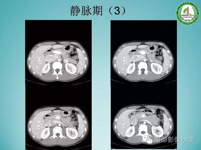 【病例】腹膜后嗜铬细胞瘤1例