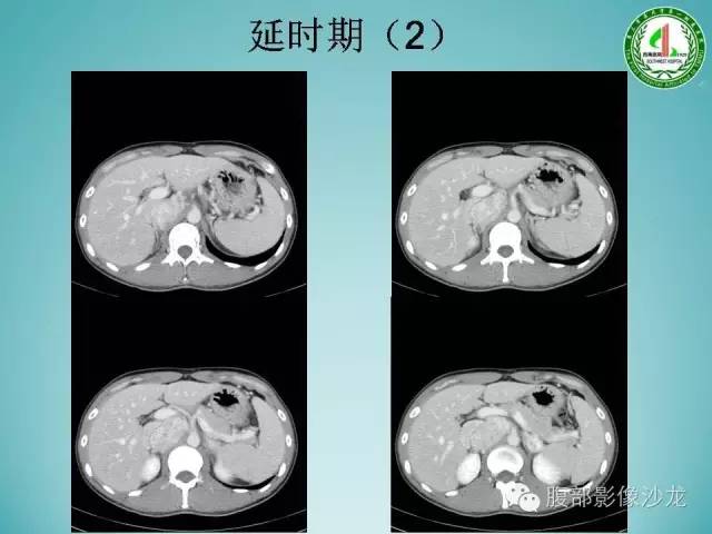 【病例】腹膜后嗜铬细胞瘤1例