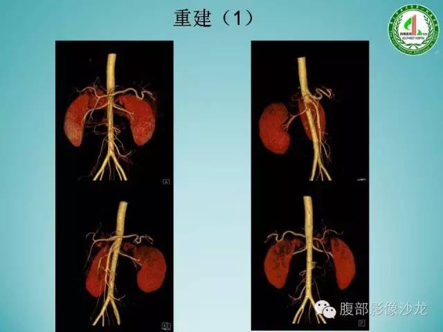 【病例】腹膜后嗜铬细胞瘤1例