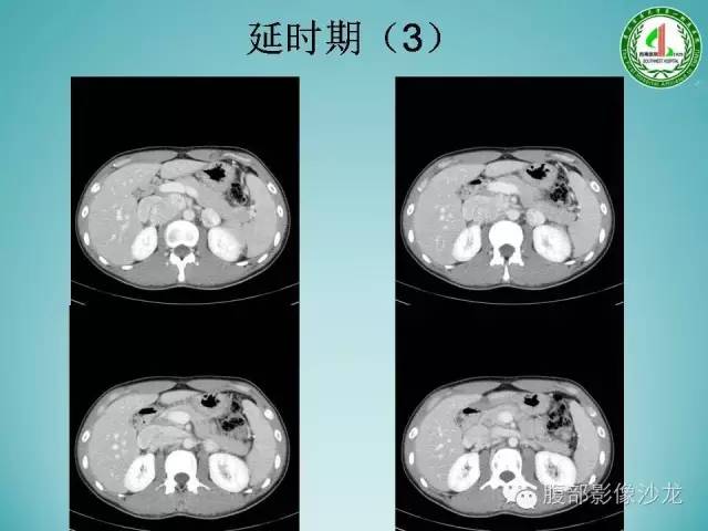 【病例】腹膜后嗜铬细胞瘤1例