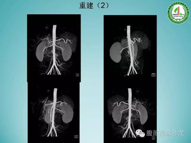 【病例】腹膜后嗜铬细胞瘤1例