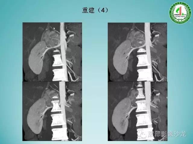 【病例】腹膜后嗜铬细胞瘤1例