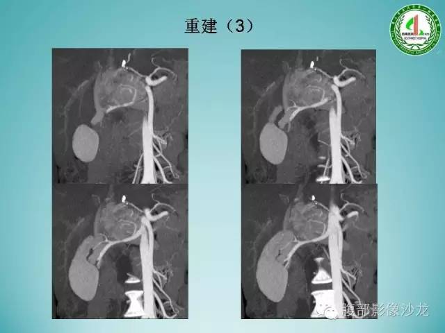 【病例】腹膜后嗜铬细胞瘤1例