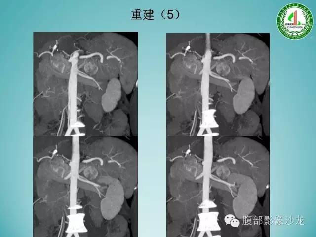 【病例】腹膜后嗜铬细胞瘤1例