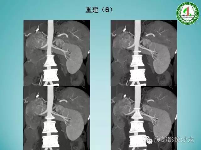 【病例】腹膜后嗜铬细胞瘤1例