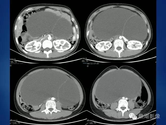 【病例】浆液性、黏液性混合型囊腺瘤1例CT影像表现