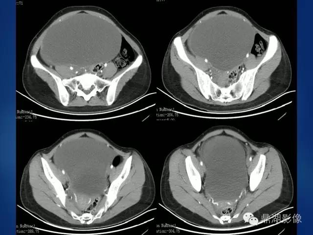 【病例】浆液性、黏液性混合型囊腺瘤1例CT影像表现