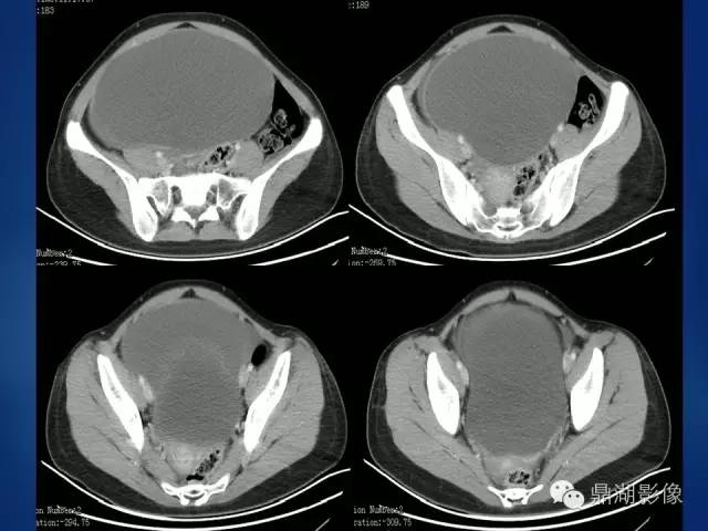 【病例】浆液性、黏液性混合型囊腺瘤1例CT影像表现