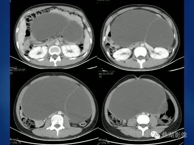 【病例】浆液性、黏液性混合型囊腺瘤1例CT影像表现