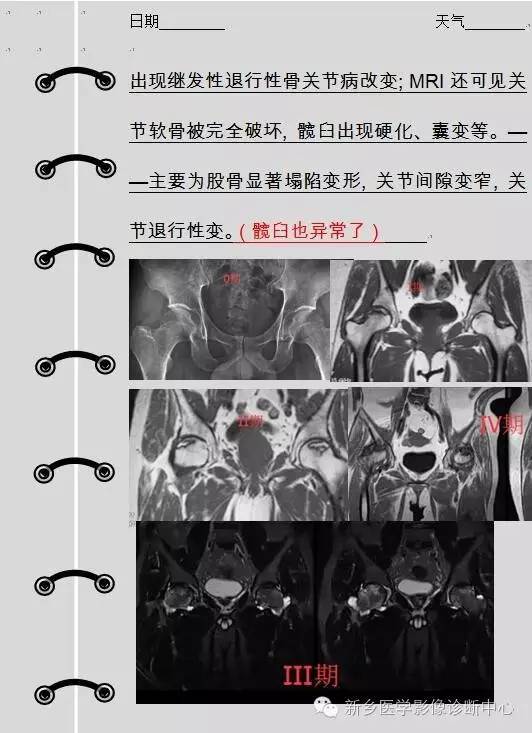 股骨头坏死术前术后影像那些事