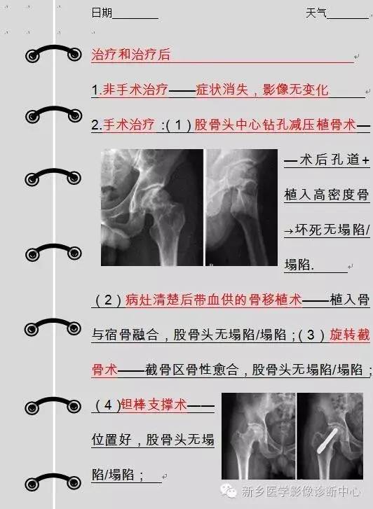 股骨头坏死术前术后影像那些事
