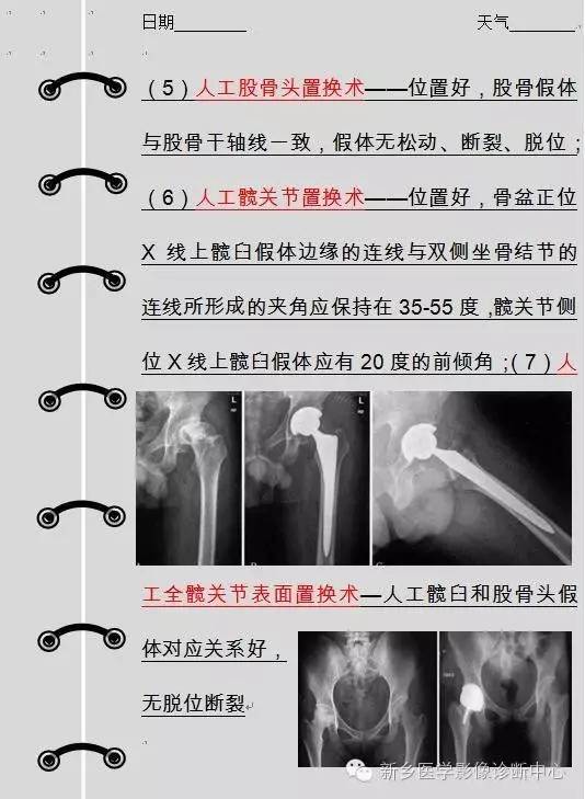 股骨头坏死术前术后影像那些事