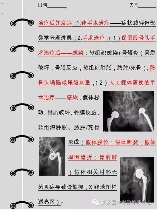 股骨头坏死术前术后影像那些事