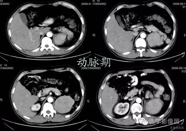 【病例】腹膜后副脾1例CT影像表现