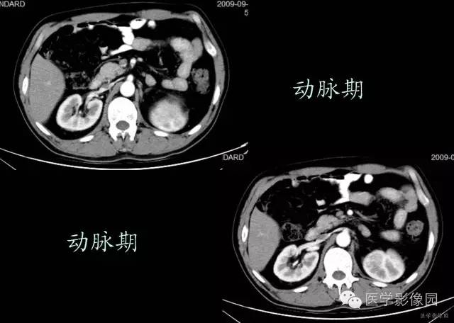 【病例】腹膜后副脾1例CT影像表现